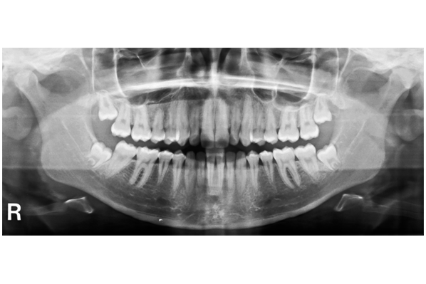 歯科用パノラマによるレントゲン