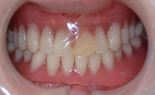 オーダー義歯